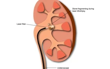 Lấy sỏi thận sao cho nhanh, ít di chứng?
