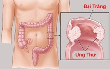 Làm sao để phát hiện và chẩn đoán sớm ung thư đại - trực tràng