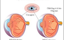 Các bệnh võng mạc thường gặp