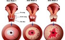 Sàng lọc phát hiện sớm ung thư cổ tử cung