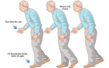 Những điều cần biết về bệnh Parkinson