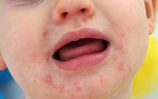 Sốt xuất huyết chưa qua, tay chân miệng đã đến