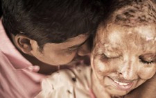 Mặt biến dạng vì axit, cô gái xúc động vì được cầu hôn