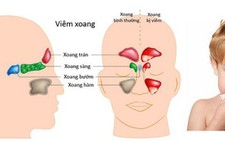 Viêm xoang mạn tính kéo dài do trào ngược dạ dày-thực quản