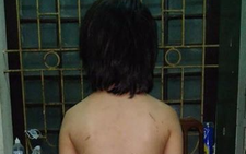 Bé trai sút 20kg nghi do cha ruột bạo hành