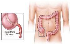 Những điều cần biết về viêm ruột thừa