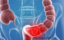 Phòng bệnh viêm đại tràng
