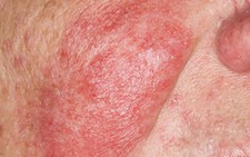 Phân biệt dị ứng thuốc thật - dị ứng thuốc giả