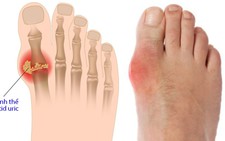 Cách phòng chống bệnh gout
