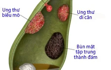 Chẩn đoán và xử trí polyp túi mật