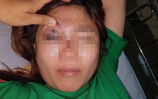 Mất thị lực do bạn trai tiêm chất làm đầy nâng mũi