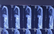 Cứu cháu bé 9 tuổi có thể nguy kịch chỉ vì một vết xước