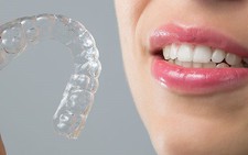 Niềng răng không mắc cài có ưu điểm gì?