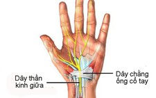 Hội chứng ống cổ tay
