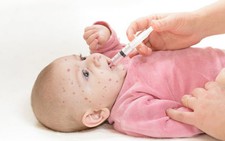 Cách xử trí sốt phát ban tại nhà