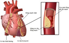Rối loạn lipid máu và cách phòng ngừa