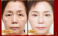 Phương pháp Laser Liposonic xóa nhăn, phục hồi da chảy xệ