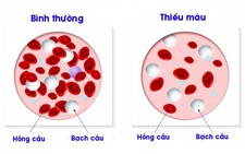 Hội chứng thiếu máu