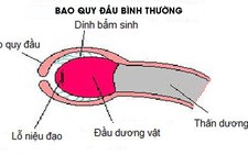 Đừng đưa bé đi nong bao quy đầu quá sớm!