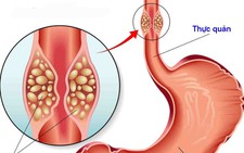 6 dấu hiệu nhận biết ung thư thực quản