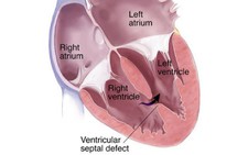 Biểu hiện thường gặp ở trẻ bị bệnh tim bẩm sinh và cách điều trị.