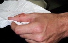 Cách xử trí khi “đụng độ” rắn
