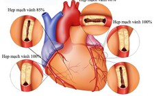 Hiểu biết về bệnh động mạch vành