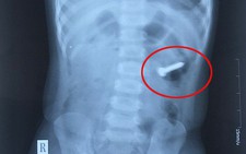 Bé gái 2 tuổi nuốt đinh xoắn 3cm