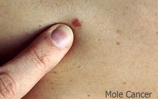 Nguyên nhân, dấu hiệu và cách phòng tránh ung thư da