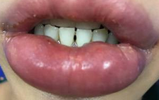 Lại một phụ nữ gặp tai biến vì bơm môi ở thẩm mỹ viện