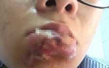 Bát nháo dịch vụ làm đẹp - Kỳ 2: Tiền mất tật mang