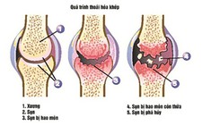 Ngừa thoái hóa khớp gối đúng cách