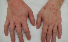 Một số thuốc điều trị viêm da cơ địa