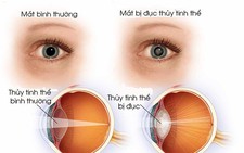 Bệnh đục thủy tinh thể và cách phòng ngừa