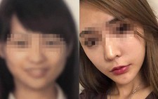 Không qua được cổng an ninh vì phẫu thuật thẩm mỹ