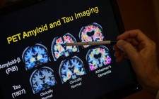 Có thể 'trị' bệnh Alzheimer mà không cần đến thuốc