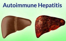 Viêm gan tự miễn trẻ em