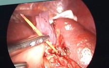 Nhậu quá chén ngậm cây tăm ngủ quên, thủng luôn lá lách