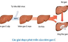 Biểu hiện viêm gan C ở phụ nữ