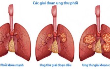 Điều trị ung thư phổi