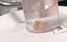 Bé gái suýt chết vì răng rơi xuống phổi