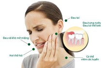 Giảm đau khi mọc răng khôn