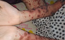 Bé gái Việt Nam đầu tiên mắc bệnh chỉ 38 bệnh nhi thế giới mắc phải