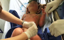 Cô giáo đốt cồn dạy phòng chống cháy nổ làm 3 trẻ mầm non bỏng nặng