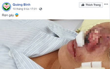 Quảng Bình bác tin đồn có bệnh nhân nhiễm 'vi khuẩn ăn thịt người' Whitmore
