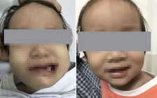 Bé gái 17 tháng tuổi bị viêm xương chũm cấp, biến chứng méo miệng