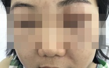 Mặt sưng phù, nổi mẩn đỏ vì tiêm 'tế bào gốc Hàn Quốc'
