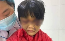 Bé gái 6 tuổi bị mẹ ruột đánh thâm tím mặt, tinh thần hoảng loạn