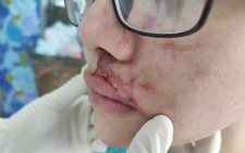 Tiêm filler vùng mặt, cô gái trẻ phải nhập viện vì nhiễm trùng