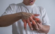 Làm gì để phòng ngừa bệnh gout?